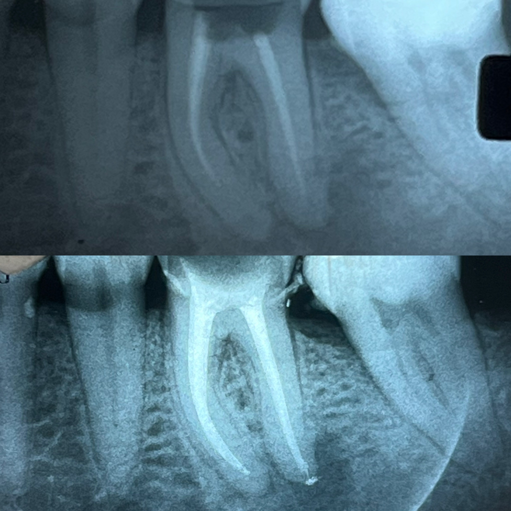 Radiografias inicial e final de retratamento endodôntico do dente 36